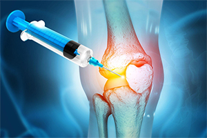 Platelet-rich plasma (PRP) Therapy for Arthritis